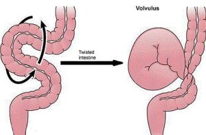 Symptoms of Bowel Obstruction