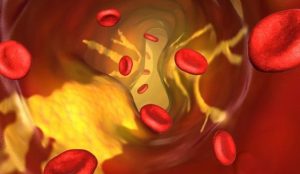 Symptoms of High Cholestrol