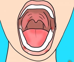 Signs and symptoms of mouth cancer