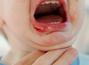 Signs and symptoms of mouth cancer
