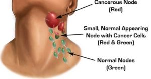 Symptoms of Breast Cancer