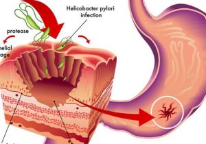 Symptoms of Stomach Cancer